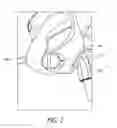 Fig. 03 - Headgear clip arrangement