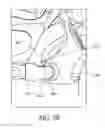 Fig. 12 - Headgear clip arrangement