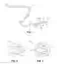 Fig. 02 - Intraperitoneal chemotherapy medical devices, kits, and methods