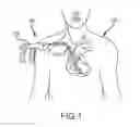 Fig. 02 - Medical device for removing an implanted object