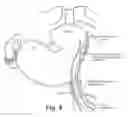 Fig. 06 - Devices, systems, and methods for treating obstetric and gynecological disorders