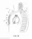 Fig. 03 - Tachyarrhythmia induction by an extra-cardiovascular implantable cardioverter defibrillator
