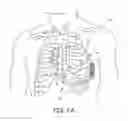 Fig. 04 - Tachyarrhythmia induction by an extra-cardiovascular implantable cardioverter defibrillator