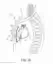Fig. 05 - Tachyarrhythmia induction by an extra-cardiovascular implantable cardioverter defibrillator