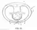 Fig. 06 - Tachyarrhythmia induction by an extra-cardiovascular implantable cardioverter defibrillator