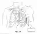 Fig. 02 - Extra-cardiovascular pacing by an implantable cardioverter defibrillator