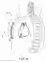 Fig. 03 - Extra-cardiovascular pacing by an implantable cardioverter defibrillator