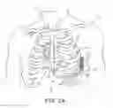 Fig. 04 - Extra-cardiovascular pacing by an implantable cardioverter defibrillator
