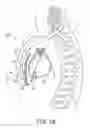 Fig. 05 - Extra-cardiovascular pacing by an implantable cardioverter defibrillator
