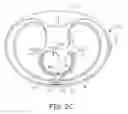 Fig. 06 - Extra-cardiovascular pacing by an implantable cardioverter defibrillator