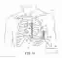 Fig. 02 - Extra-cardiovascular pacing using high-voltage therapy circuitry of an implantable cardioverter defibrillator