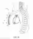Fig. 03 - Extra-cardiovascular pacing using high-voltage therapy circuitry of an implantable cardioverter defibrillator