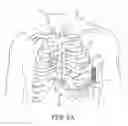 Fig. 04 - Extra-cardiovascular pacing using high-voltage therapy circuitry of an implantable cardioverter defibrillator