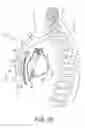 Fig. 05 - Extra-cardiovascular pacing using high-voltage therapy circuitry of an implantable cardioverter defibrillator