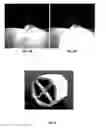 Fig. 07 - Visualizing Radiation Therapy Beam in Real-Time in the context of Patient's Anatomy