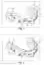 Fig. 04 - RAPID PROTOTYPED TRANSFER TRAY FOR ORTHODONTIC APPLIANCES