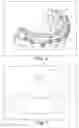 Fig. 05 - RAPID PROTOTYPED TRANSFER TRAY FOR ORTHODONTIC APPLIANCES