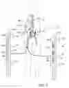 Fig. 02 - Endovascular apparatus for perfusing organs in a body