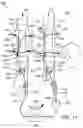 Fig. 08 - Endovascular apparatus for perfusing organs in a body