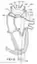 Fig. 12 - Endovascular apparatus for perfusing organs in a body