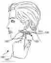 Fig. 01 - Use of adhesive patch and tension strap to reduce wrinkles in skin