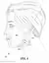 Fig. 05 - Use of adhesive patch and tension strap to reduce wrinkles in skin