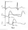 Fig. 04 - Device and method for obtaining pulse transit time and/or pulse wave velocity information of a subject