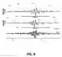Fig. 10 - Detection of disturbed blood flow