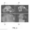 Fig. 06 - Image registration and guidance using concurrent X-plane imaging