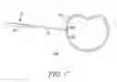 Fig. 18 - Surgical access system and related methods