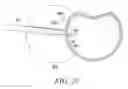 Fig. 21 - Surgical access system and related methods