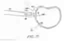 Fig. 26 - Surgical access system and related methods