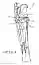 Fig. 02 - RETRACTOR TOOLS FOR MINIMALLY INVASIVE HIP SURGERY