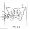 Fig. 04 - RETRACTOR TOOLS FOR MINIMALLY INVASIVE HIP SURGERY