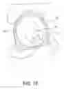 Fig. 17 - Minimally invasive bone sparing acetabular reamer