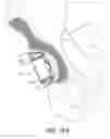 Fig. 18 - Minimally invasive bone sparing acetabular reamer