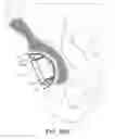 Fig. 19 - Minimally invasive bone sparing acetabular reamer
