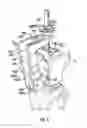 Fig. 03 - Associated instruments and methods for posterior stabilized knee preparation
