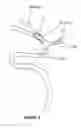 Fig. 04 - Systems and methods to improve perfusion pressure during endovascular intervention