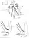 Fig. 06 - Methods and devices for diastolic assist