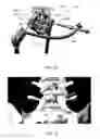 Fig. 47 - Orthopedic anchoring methods