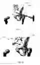 Fig. 51 - Orthopedic anchoring methods