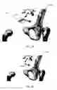 Fig. 52 - Orthopedic anchoring methods
