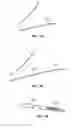 Fig. 44 - Vapor ablation system with a catheter having more than one positioning element and configured to treat duodenal tissue
