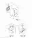 Fig. 10 - Tissue expanders, implants, and methods of use