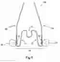 Fig. 06 - Apparatus for applying corrective forces to shape palate