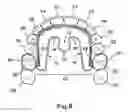 Fig. 09 - Apparatus for applying corrective forces to shape palate