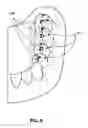 Fig. 12 - DENTAL PROSTHESES DEVICES AND METHODS
