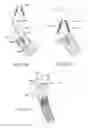 Fig. 33 - DENTAL PROSTHESES DEVICES AND METHODS