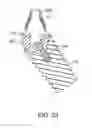 Fig. 35 - DENTAL PROSTHESES DEVICES AND METHODS